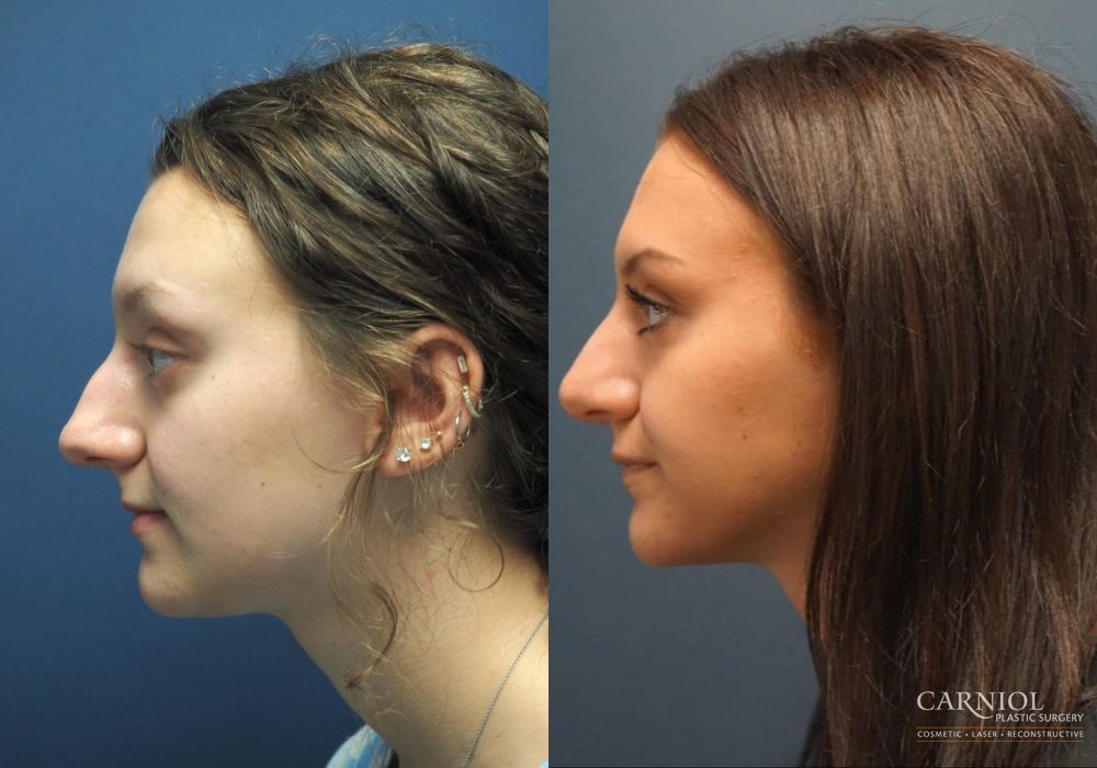 Rhinoplasty - Thumbnail 5