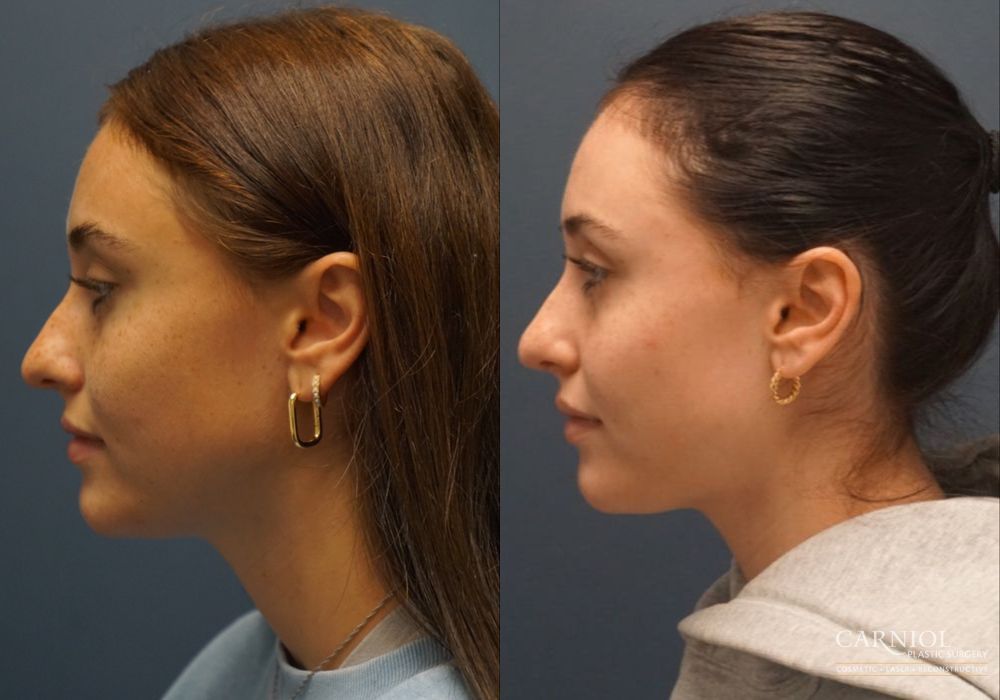 Rhinoplasty - Thumbnail 5