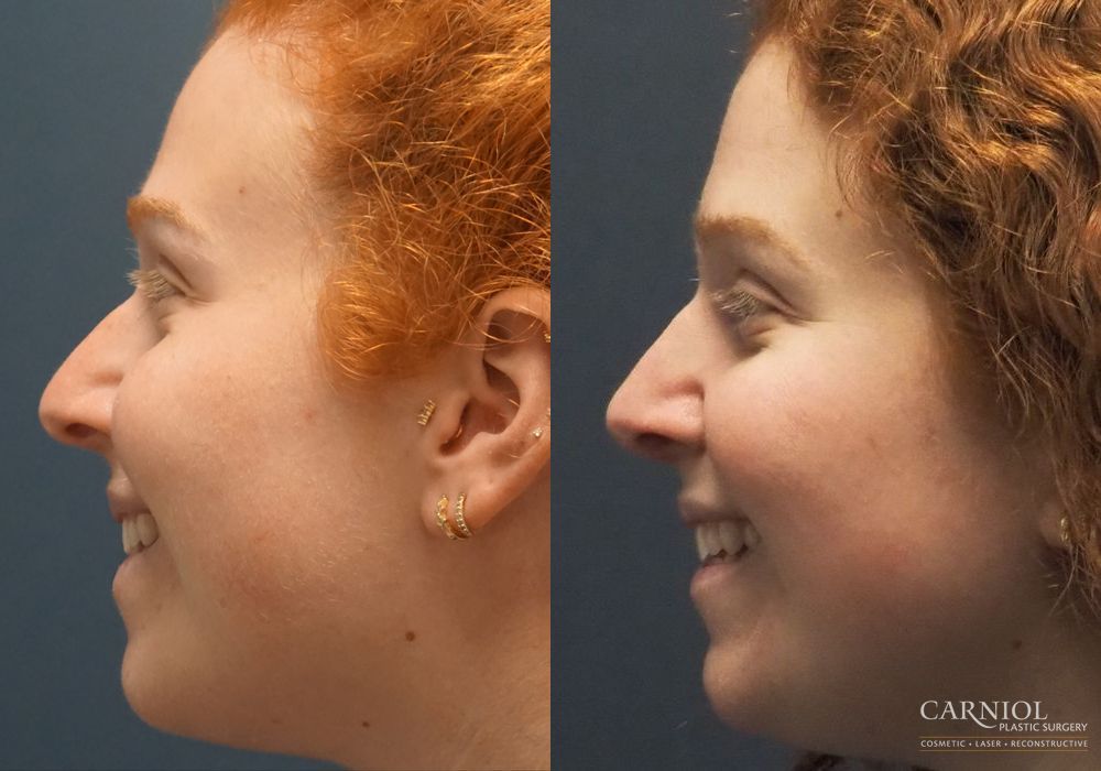 Rhinoplasty - Thumbnail 4