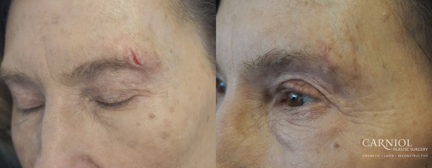 Before and after Scar Revision case 7758