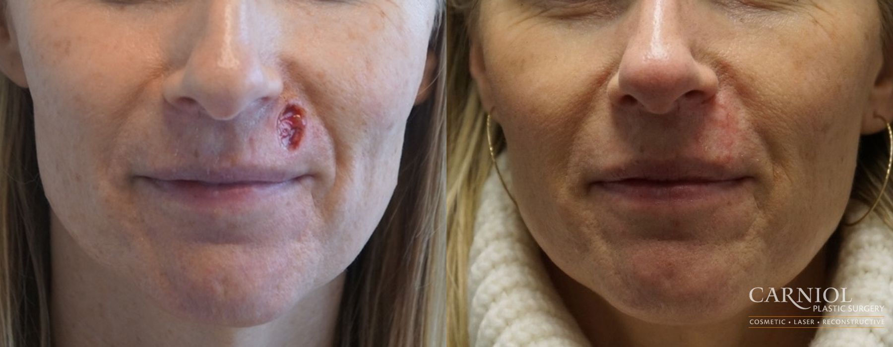 Before and after Skin Cancer Reconstruction - Face case 7789 - Angle 2