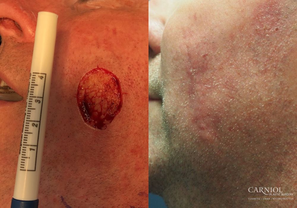 Before and after Skin Cancer Reconstruction - Face case 7777