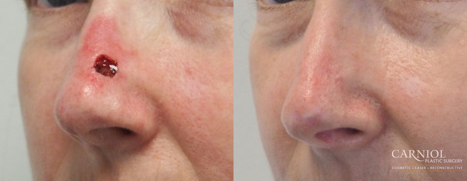 Skin Cancer Reconstruction - Face - Case 2774