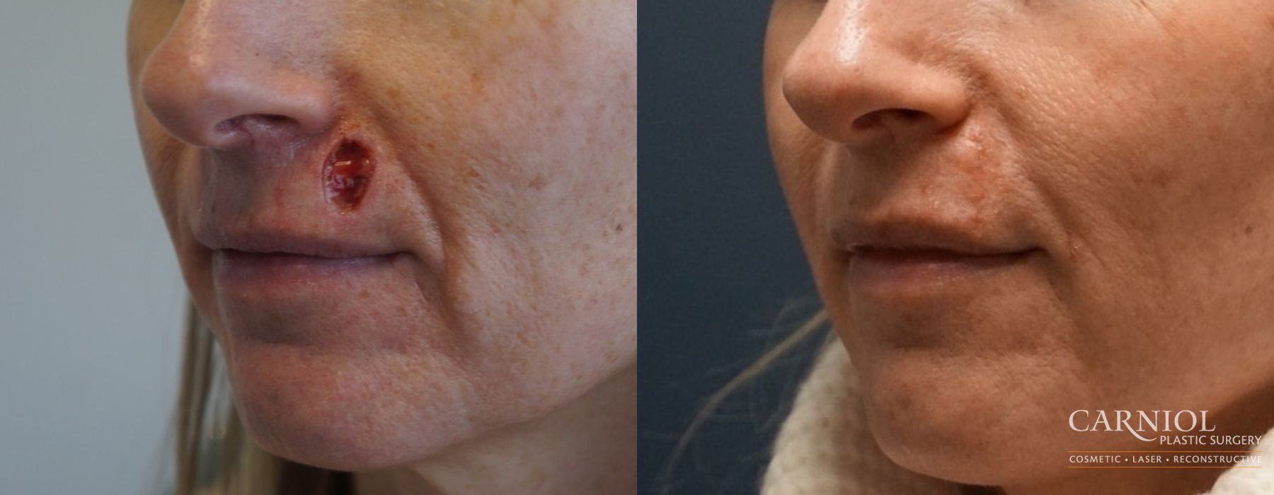 Before and after Skin Cancer Reconstruction - Face case 7789