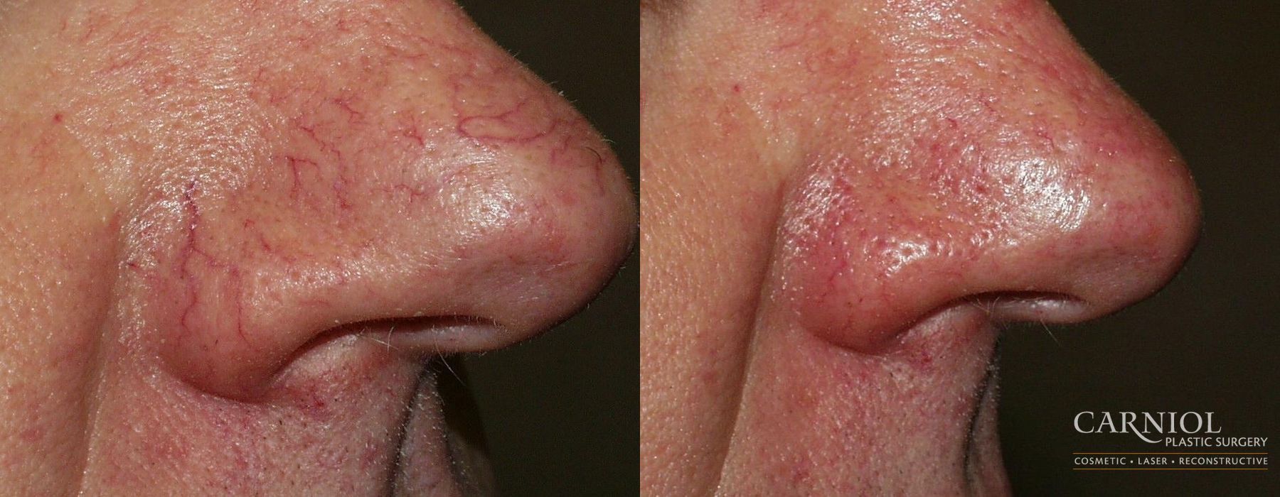 Before and after Spider Veins case 7675