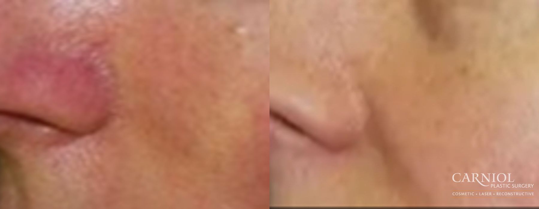 Before and after Spider Veins case 7732