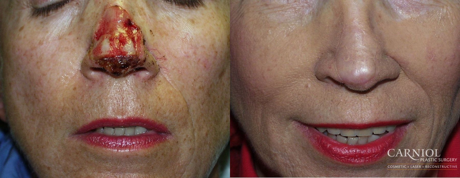 Skin Cancer Reconstruction - Face - Case 2473