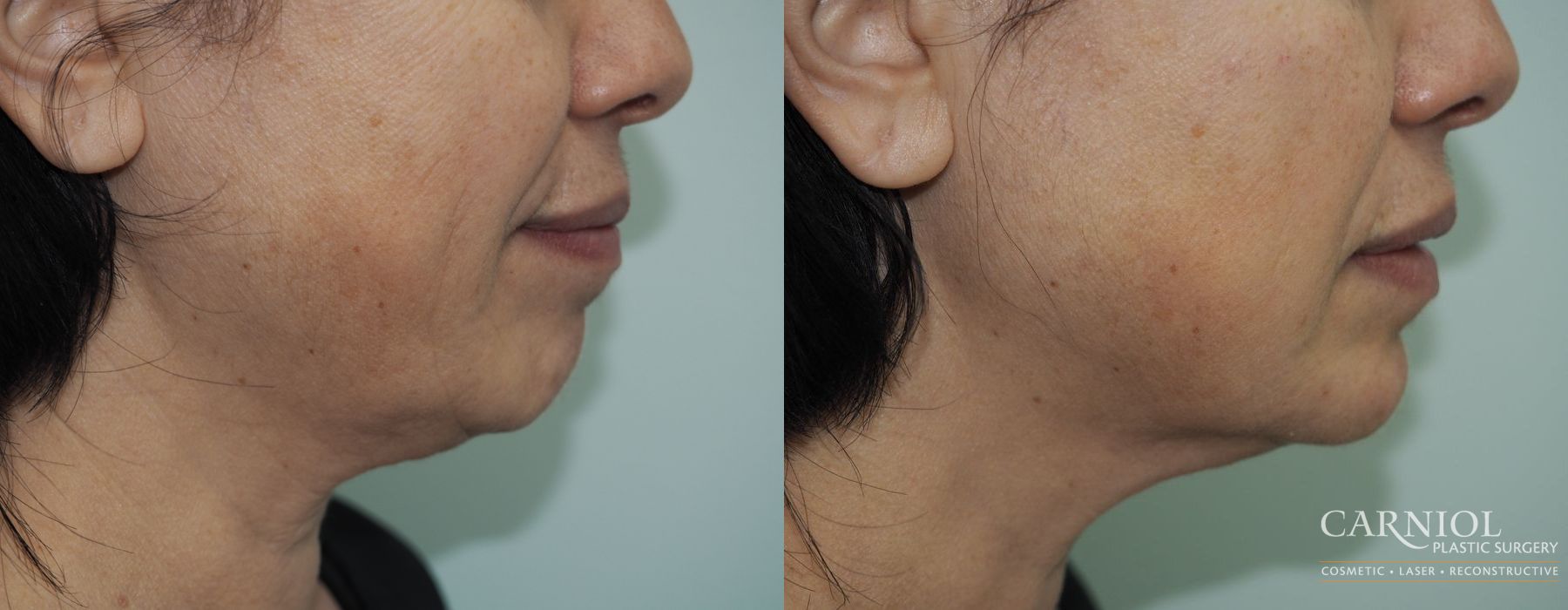 Non-Surgical Mini-Facelift - Case 2528