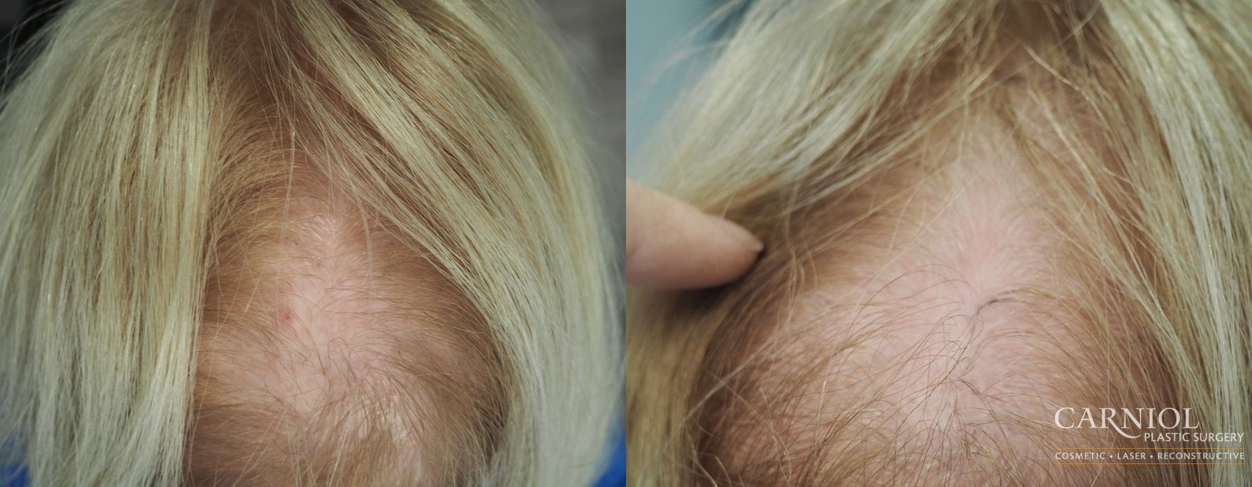Nonsurgical Hair Restoration - Case 2539
