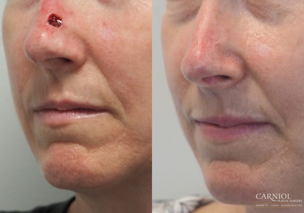 Skin Cancer Reconstruction - Face - Case 2481