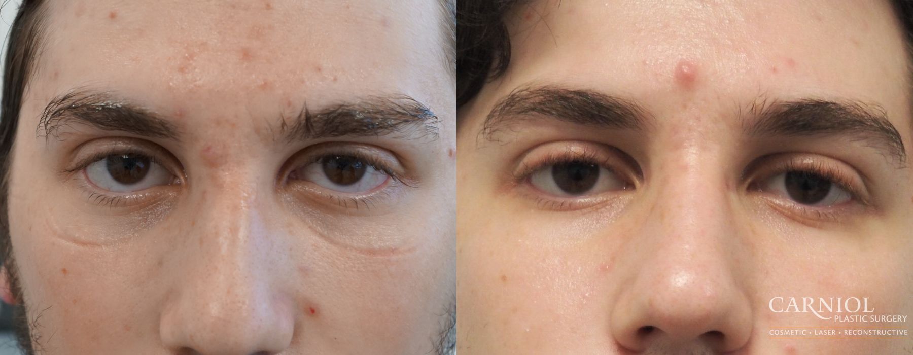 Acne Rejuvenation - Case 2411