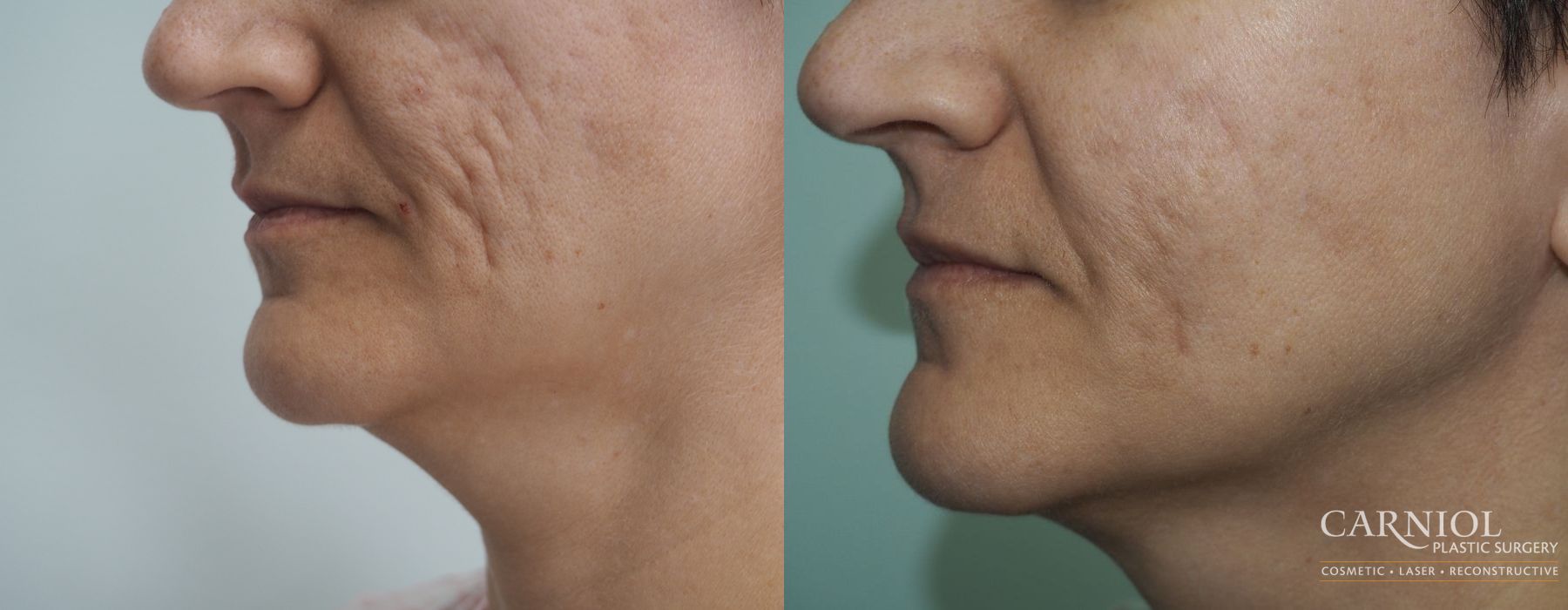 Acne Scars - Case 2485