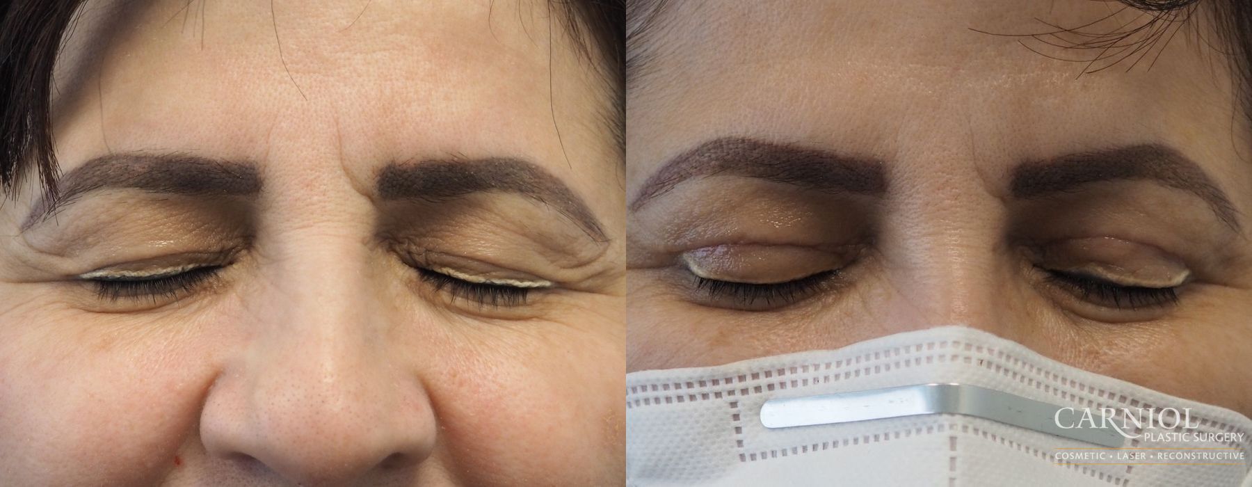 Blepharoplasty - Case 2418
