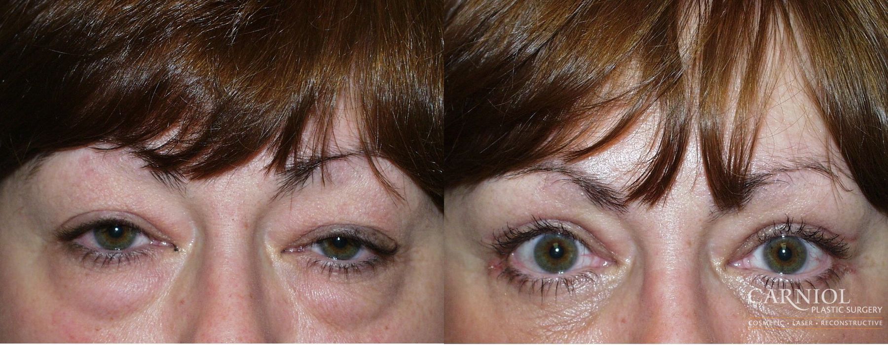 Blepharoplasty - Case 2412