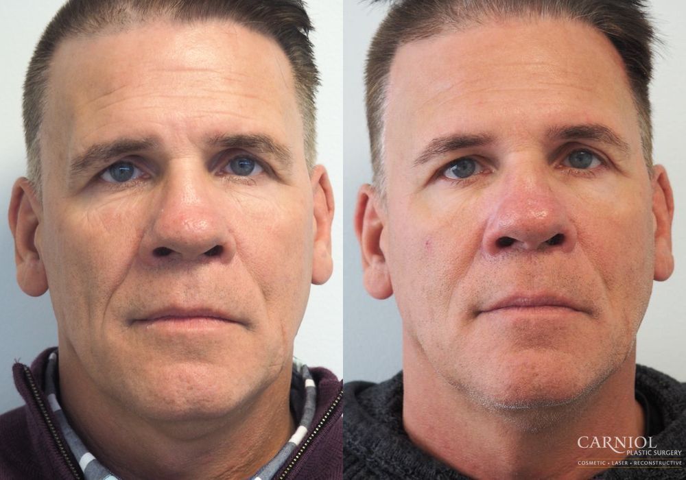 Non-Surgical Facelift - Thumbnail 2