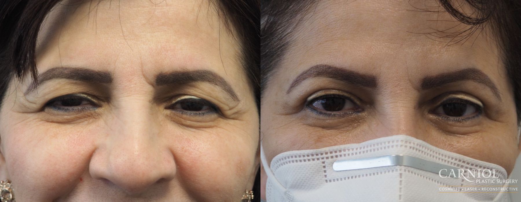 Blepharoplasty - Thumbnail 2