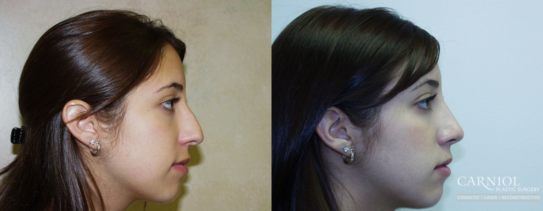 Rhinoplasty - Case 2462