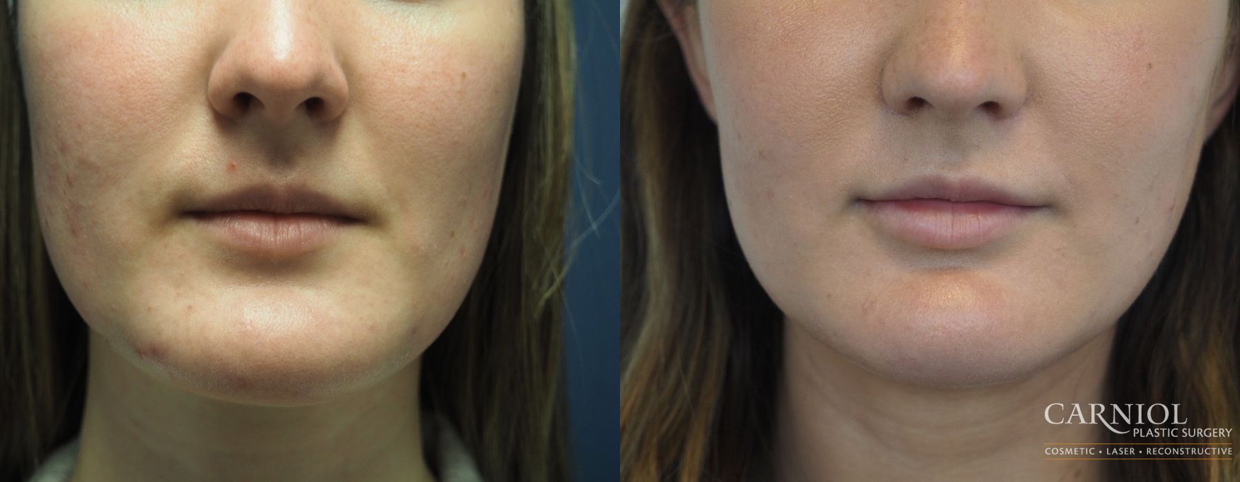 Lip Filler - Case 2445