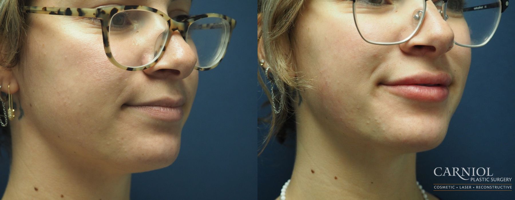 Lip Filler - Case 2446