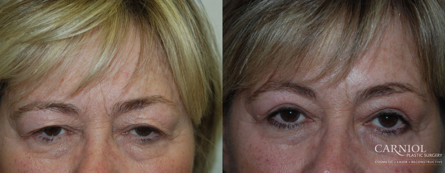 Blepharoplasty - Case 2413