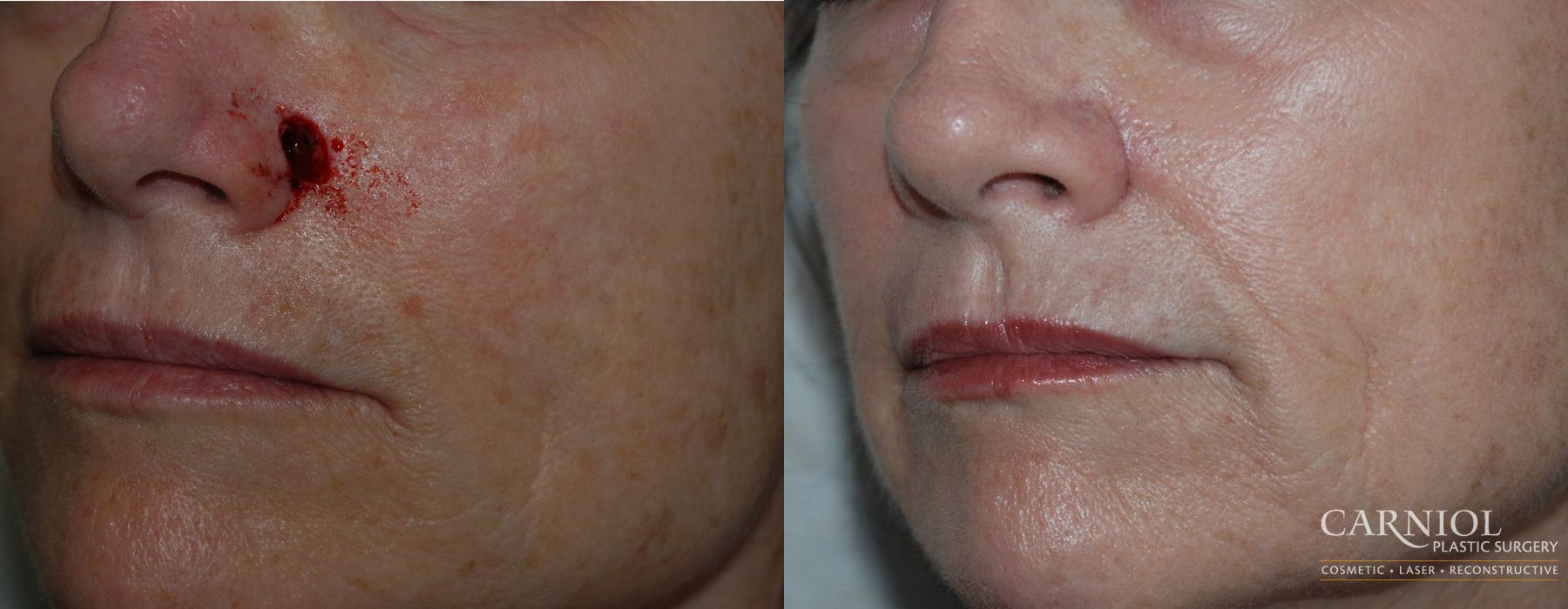 Skin Cancer Reconstruction - Face - Case 2474