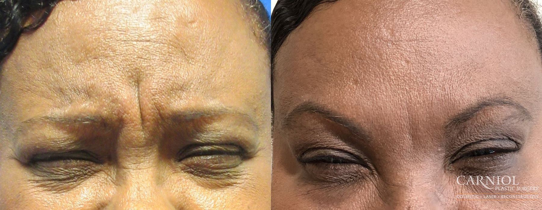 BOTOX® Cosmetic - Case 2491
