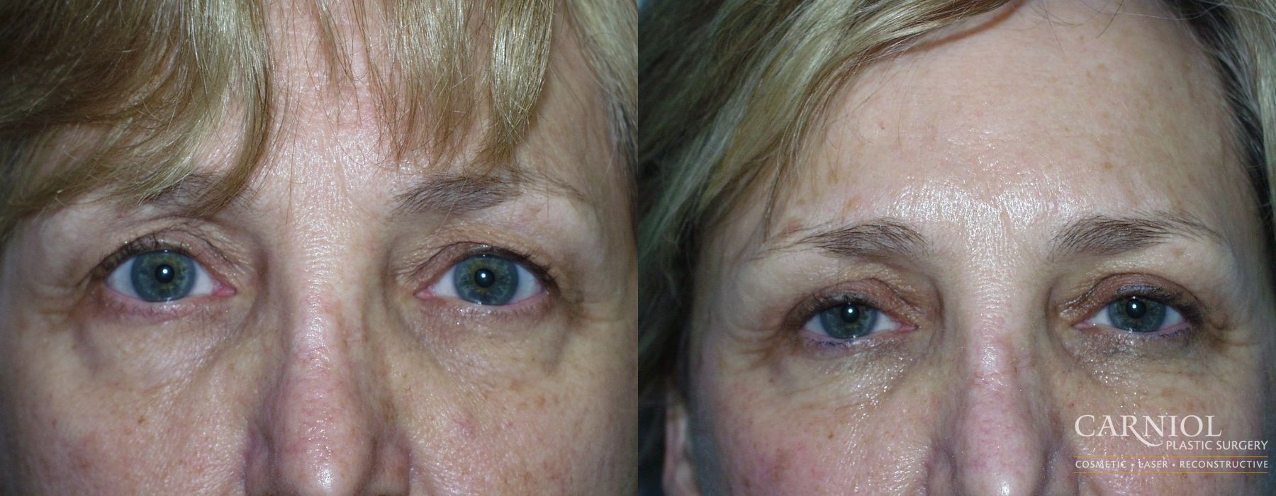 Blepharoplasty - Case 2415