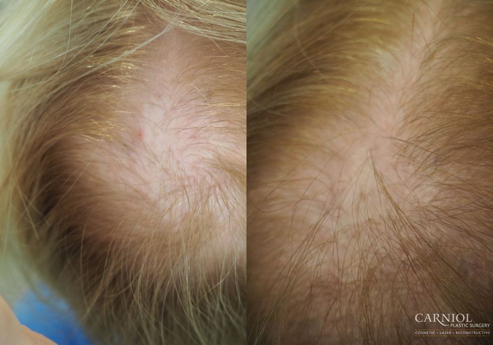 Nonsurgical Hair Restoration - Case 2538