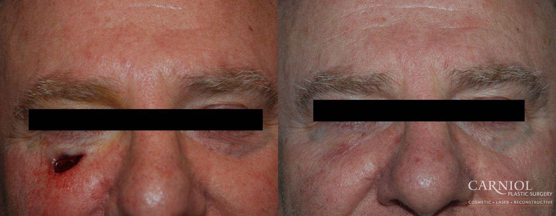 Skin Cancer Reconstruction - Face - Case 2475