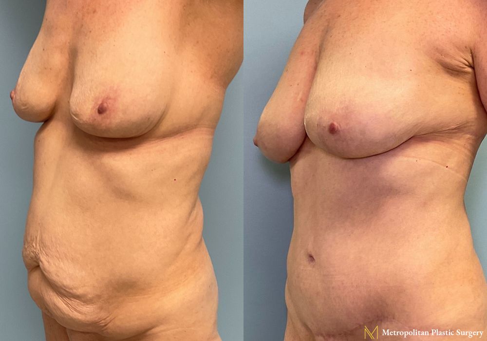 Liposuction - Thumbnail 2