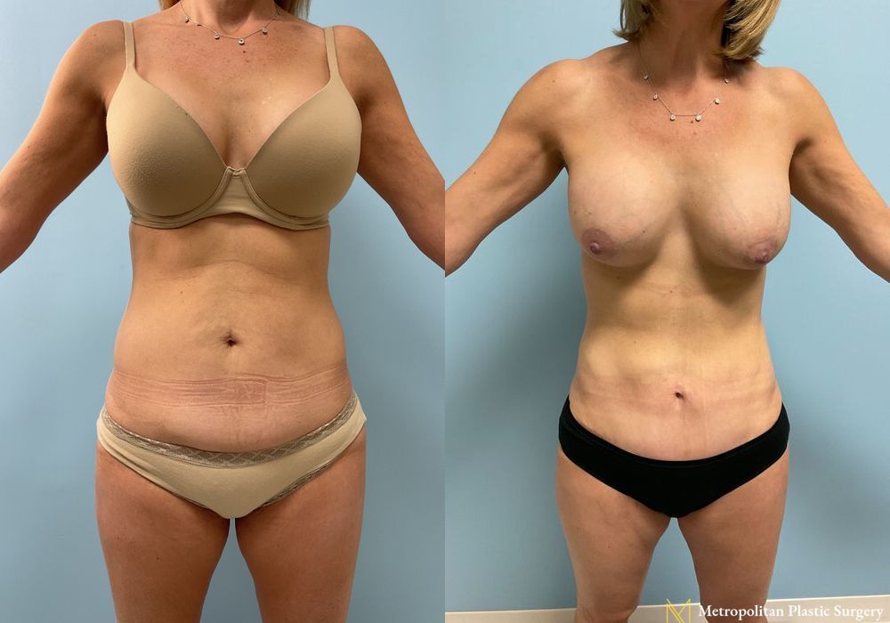 Abdominoplasty - Case 74