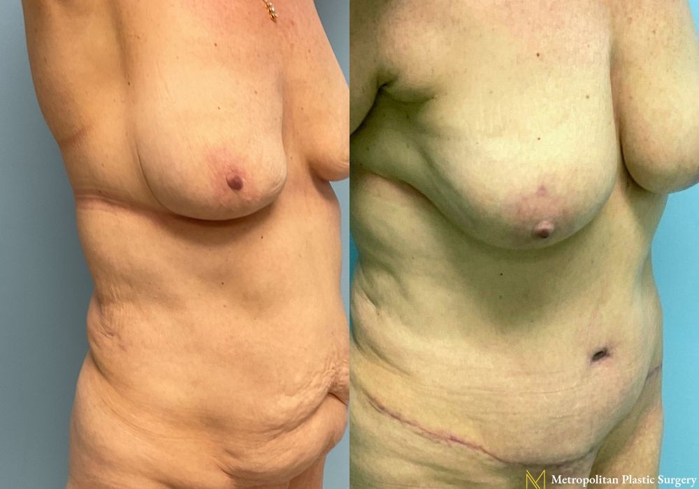 Abdominoplasty - Thumbnail 4