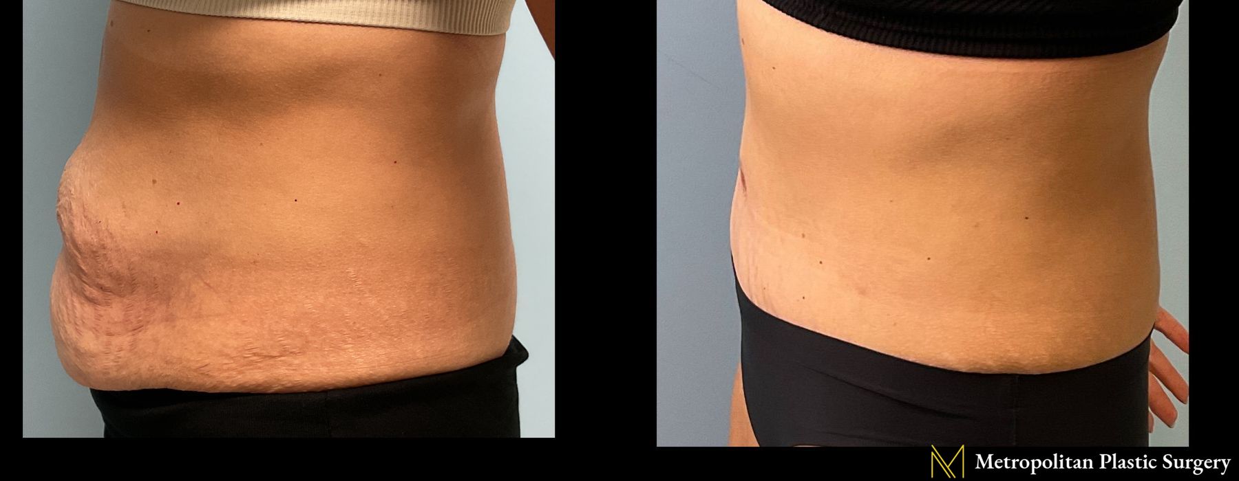 Abdominoplasty - Thumbnail 2