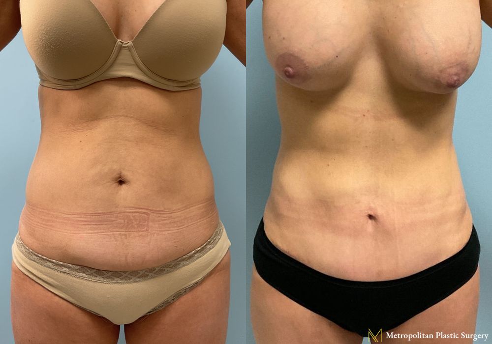 Tummy Tuck - Case 223