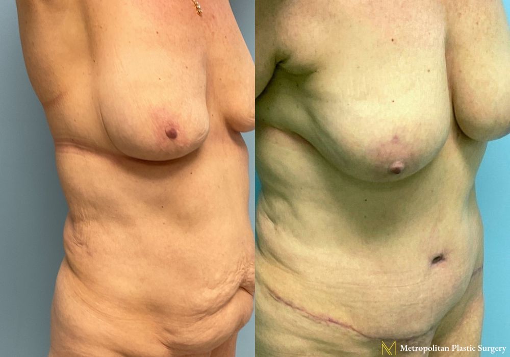 Before and after Fat Grafting case 8032 - Angle 3