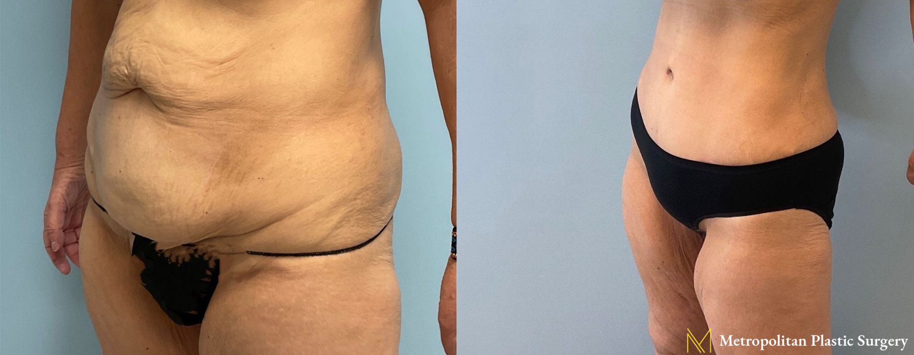 Abdominoplasty - Thumbnail 2