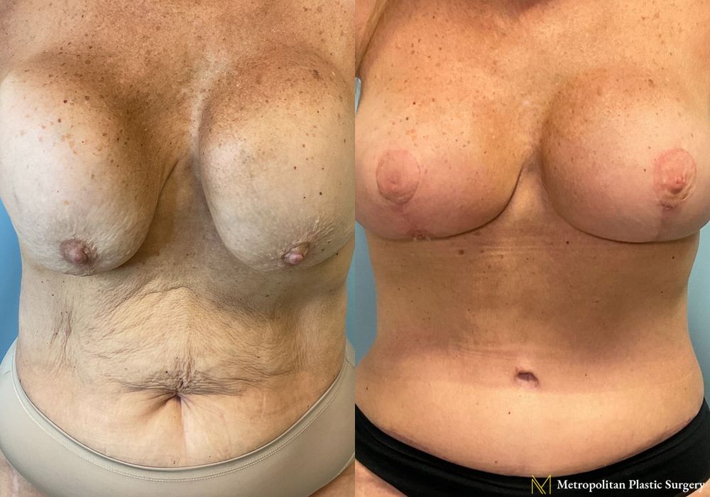 Before and after Abdominoplasty case 23903