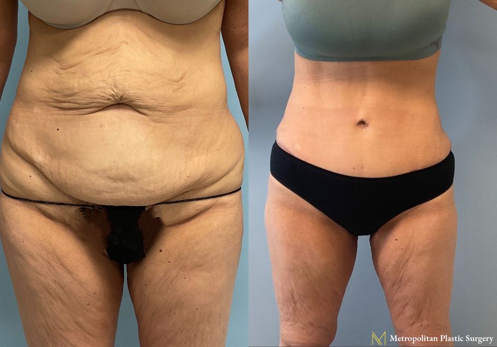 Abdominoplasty - Case 158