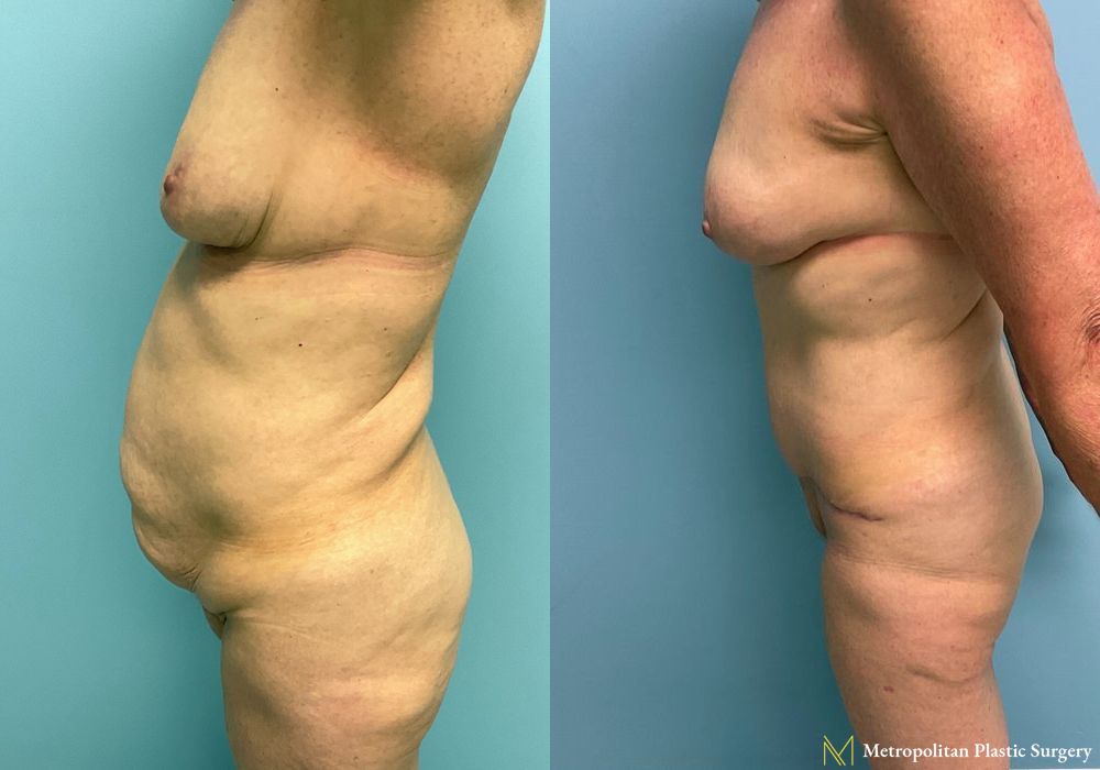 Before and after Fat Grafting case 8032 - Angle 5