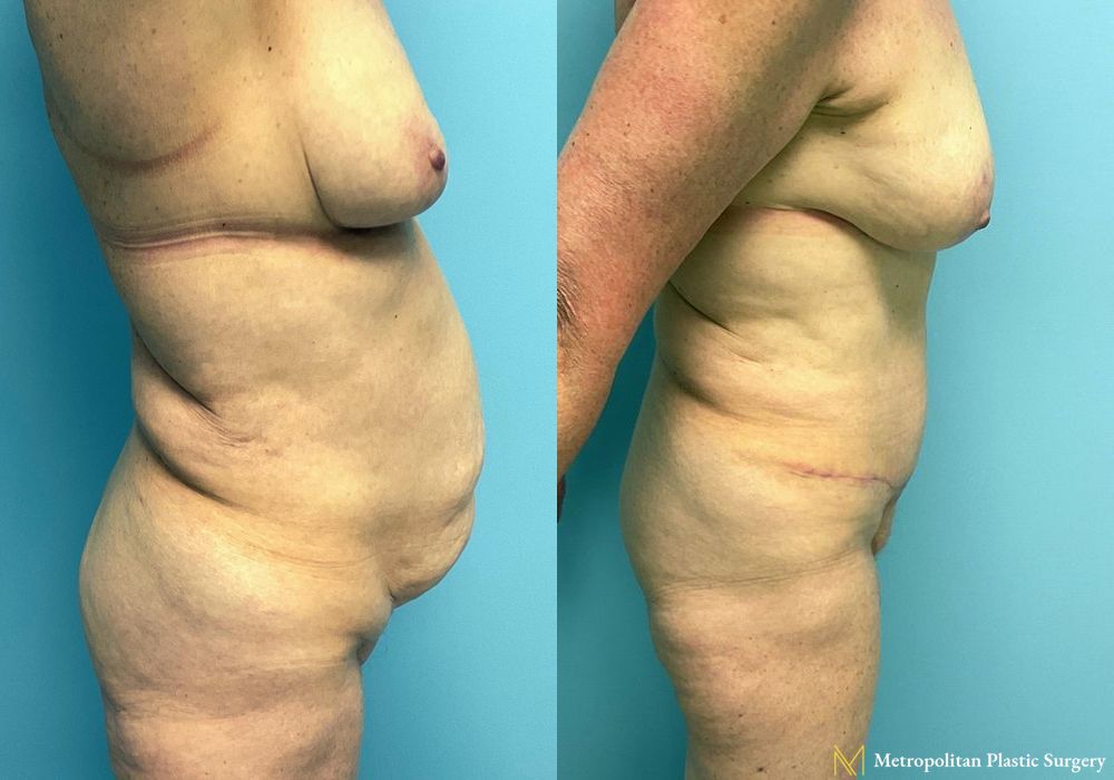 Before and after Fat Grafting case 8032 - Angle 2