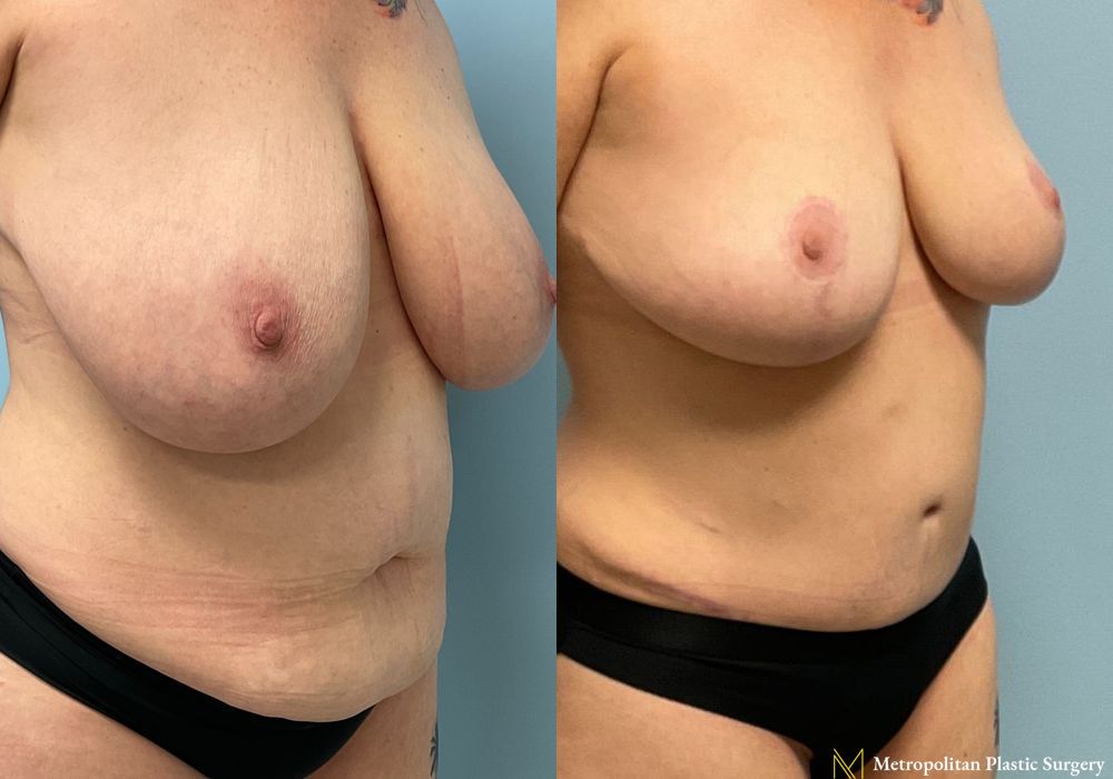 Abdominoplasty - Thumbnail 2