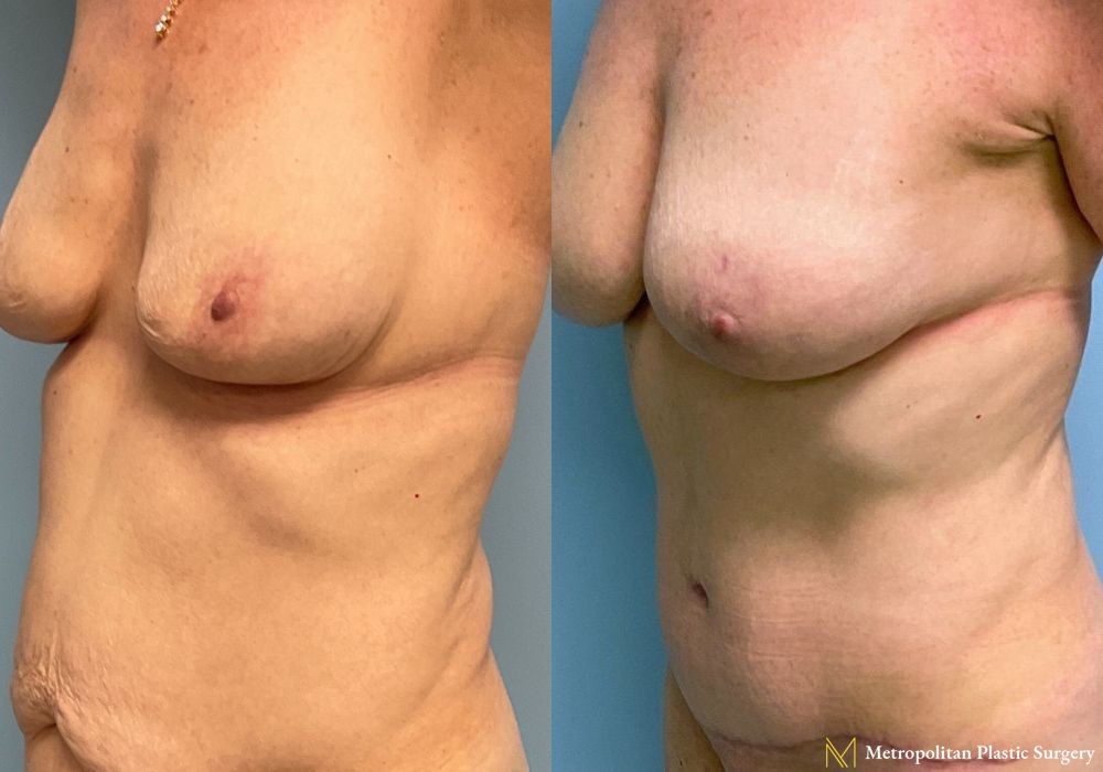 Before and after Fat Grafting case 8032 - Angle 4