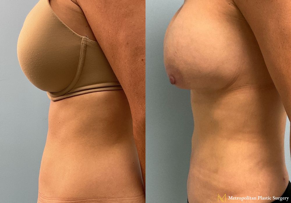 Tummy Tuck - Thumbnail 2