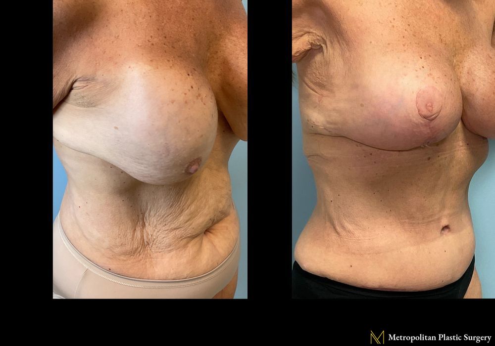 Before and after Breast Implant Removal case 23903 - Angle 3