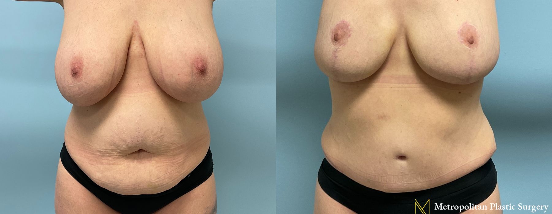 Abdominoplasty - Case 76
