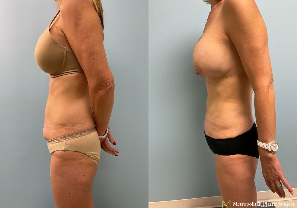 Abdominoplasty - Thumbnail 2