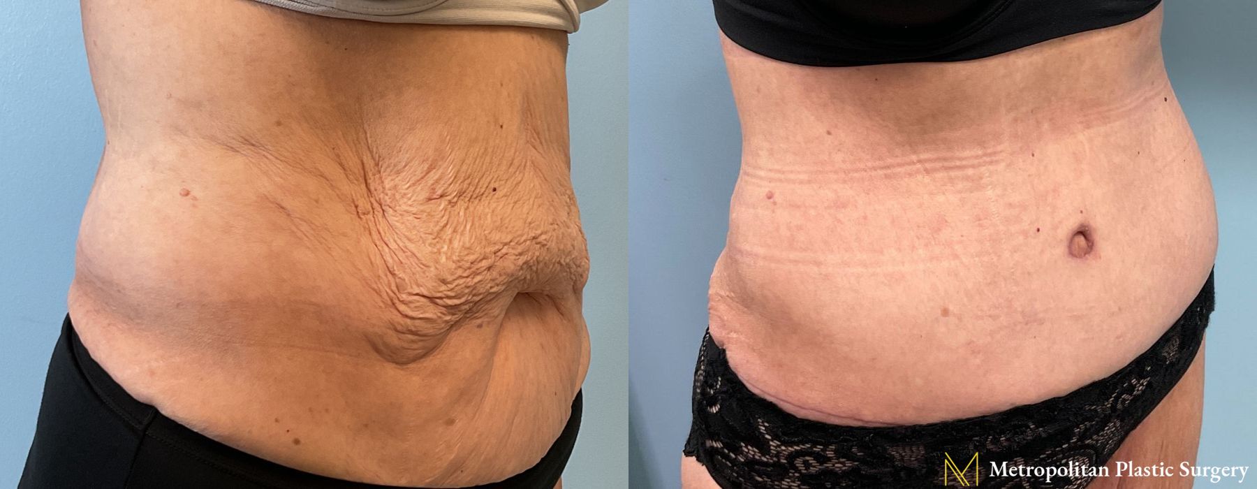 Before and after Liposuction case 26062 - Angle 2