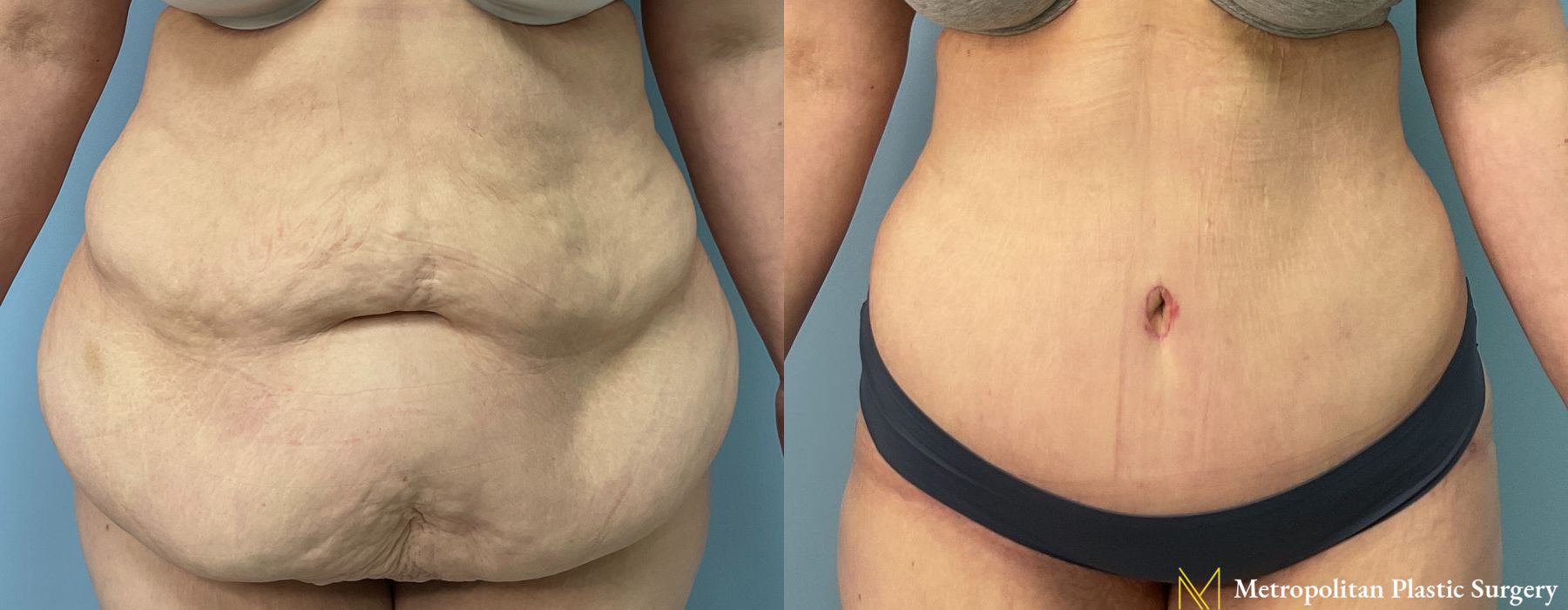 Abdominoplasty - Thumbnail 2