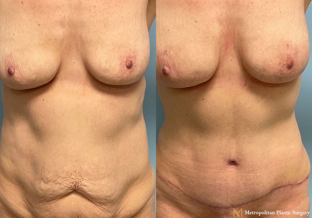 Before and after Fat Grafting case 8032