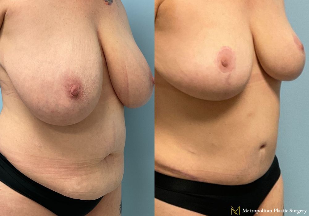 Breast Reduction - Thumbnail 2